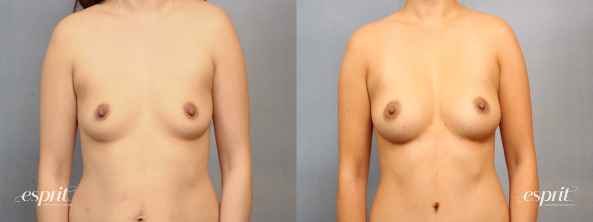 Case 1516 before and after front view esprit® cosmetic surgeons