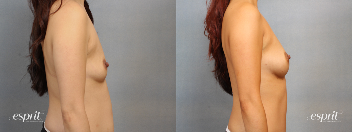 Case 1516 before and after right side view esprit® cosmetic surgeons