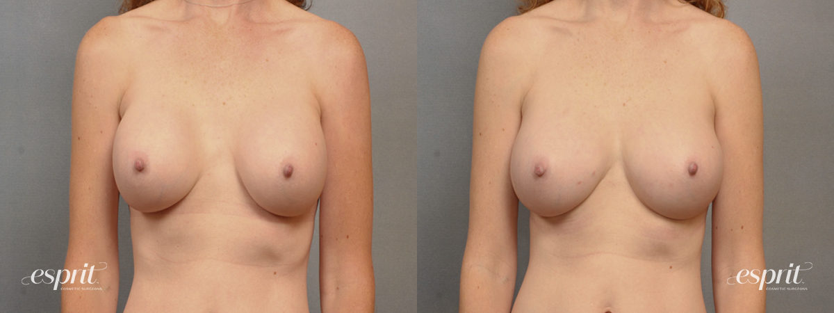 Case 1536 before and after front view esprit® cosmetic surgeons