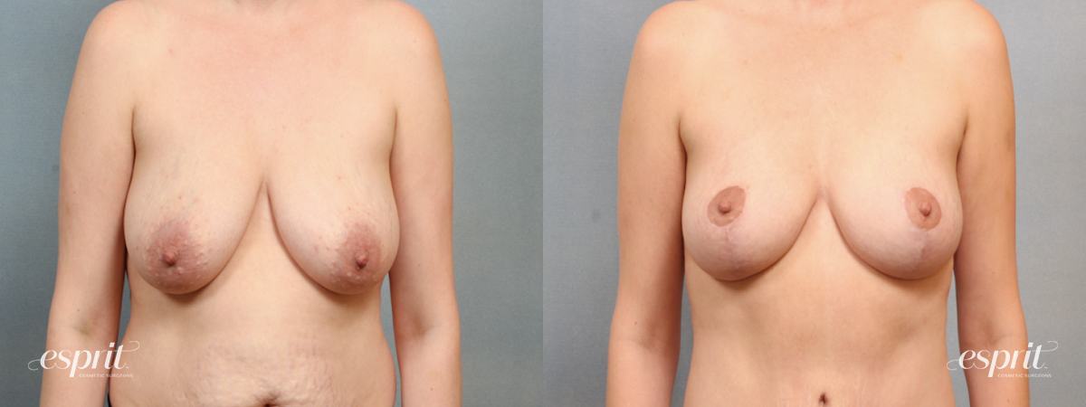 Case 1559 before and after front view esprit® cosmetic surgeons