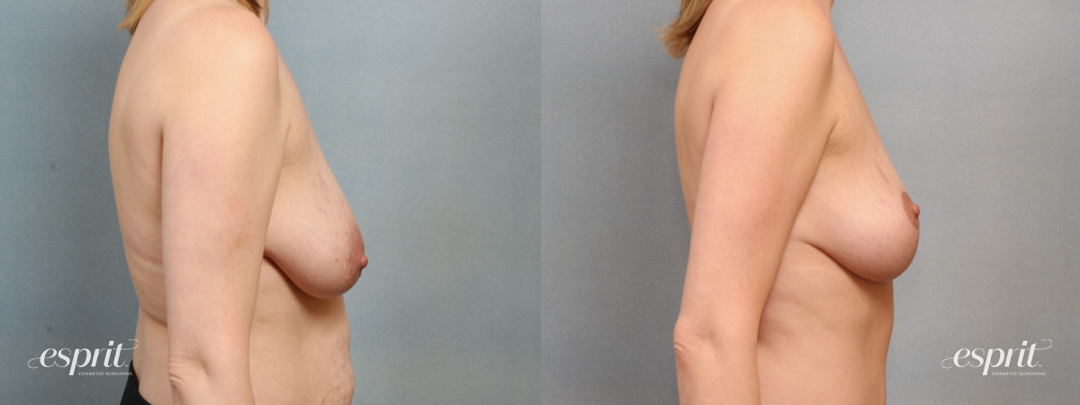 Case 1559 before and after right side view esprit® cosmetic surgeons