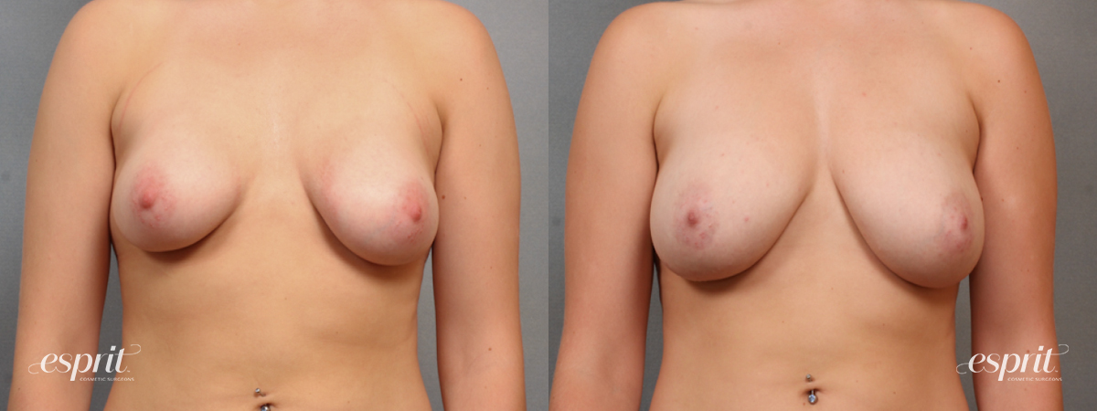 Case 1581 before and after front view esprit® cosmetic surgeons