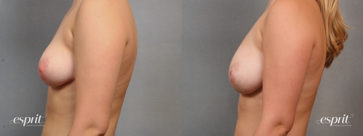 Case 1581 before and after left side view esprit® cosmetic surgeons