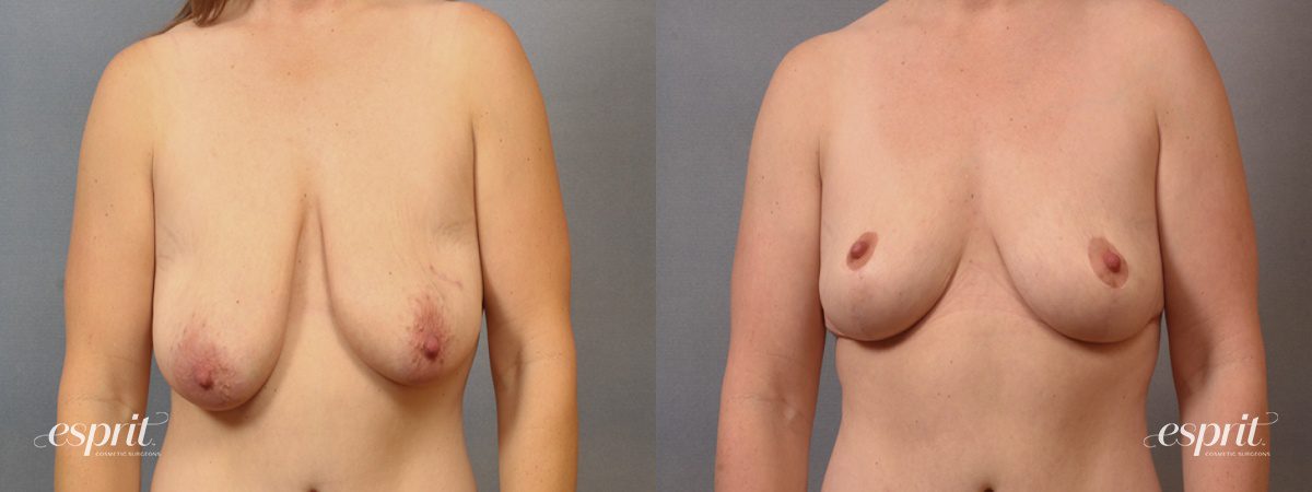 Case 1607 before and after front view esprit® cosmetic surgeons