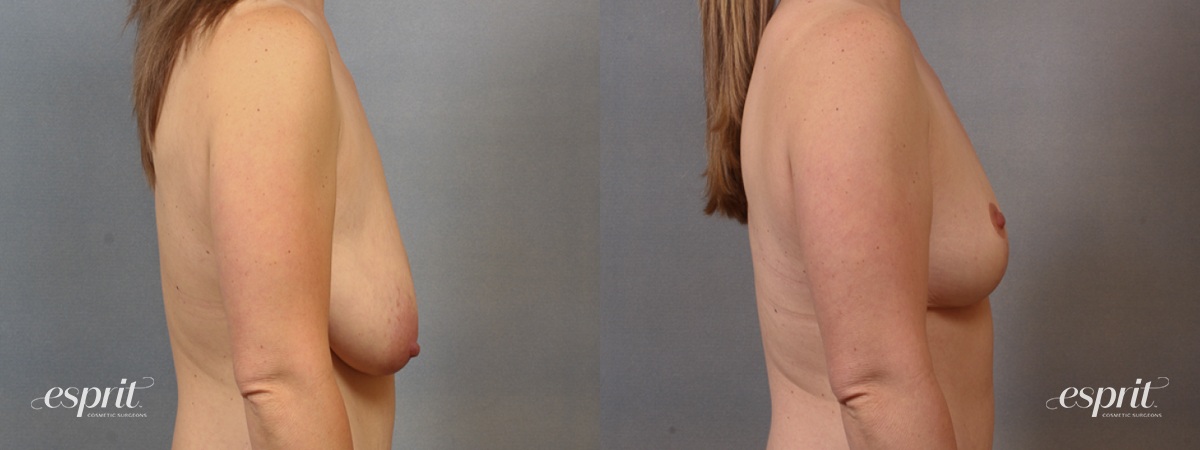 Case 1607 before and after right side view esprit® cosmetic surgeons