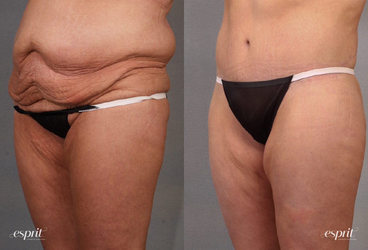 Case 1621 before and after left oblique view esprit® cosmetic surgeons