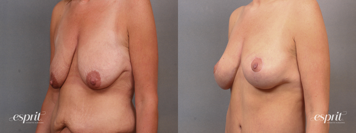 Case 1622 Before and After Left Oblique View