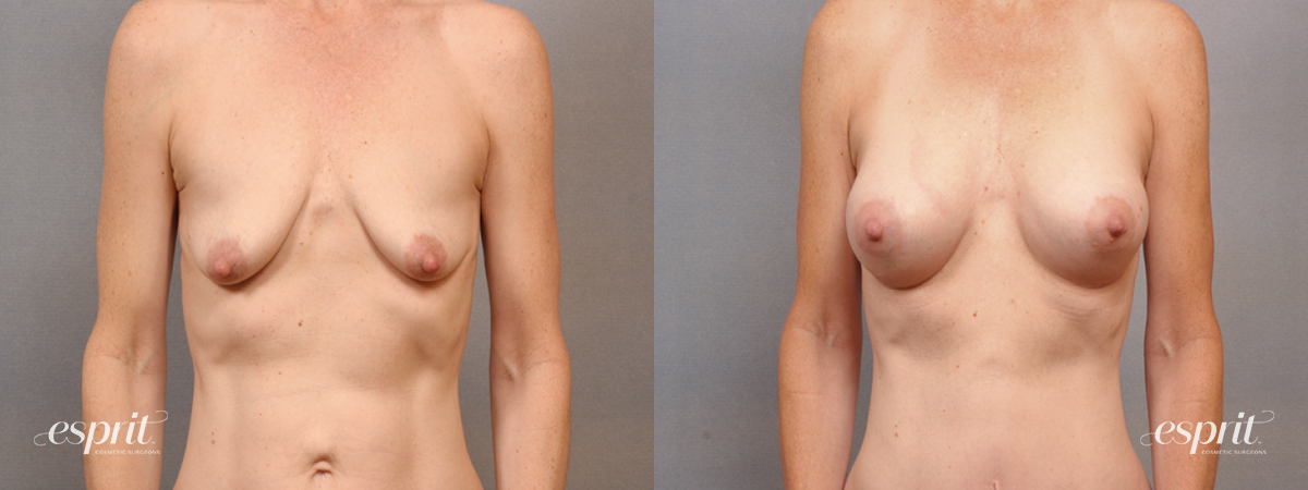 Case 1627 before and after front view esprit® cosmetic surgeons