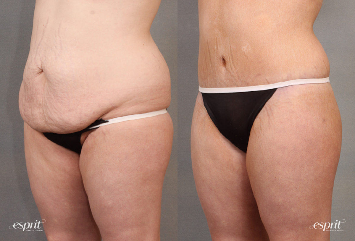 Case 1638 before and after left oblique view esprit® cosmetic surgeons