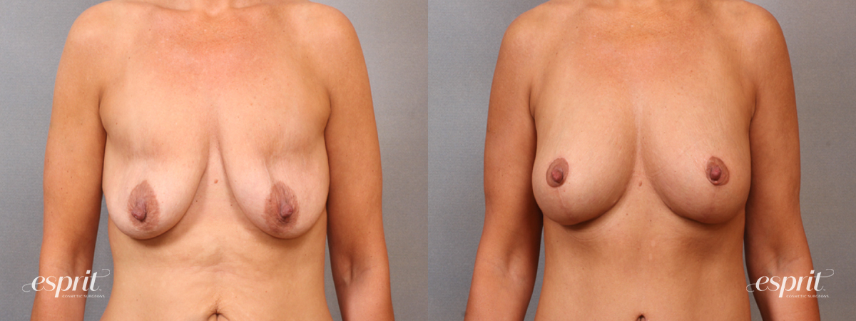 Case 1641 before and after front view esprit® cosmetic surgeons