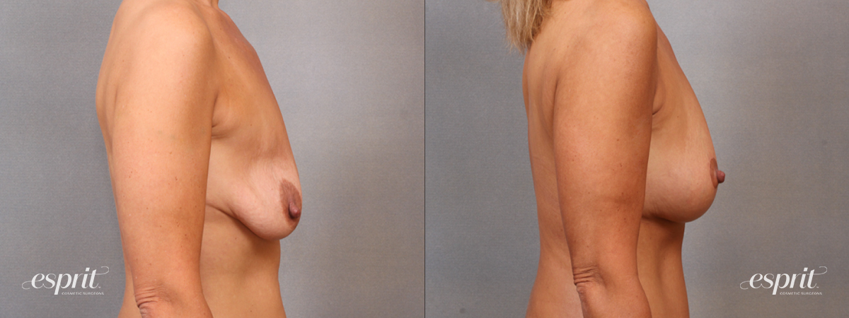 Case 1641 before and after right side view esprit® cosmetic surgeons