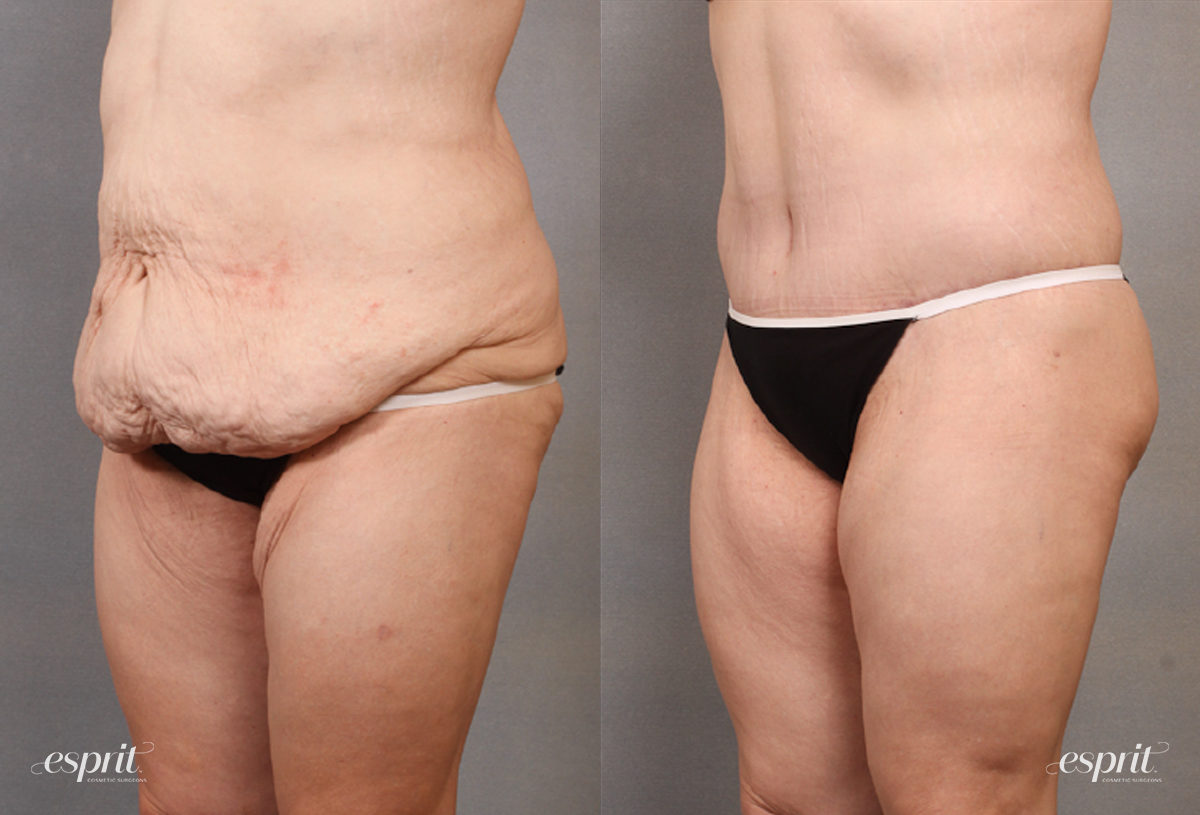 Case 1665 before and after left oblique view esprit® cosmetic surgeons