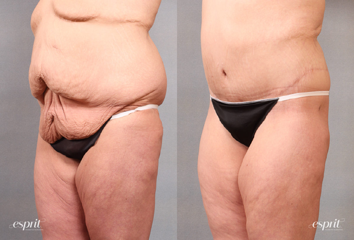 Case 1683 before and after left oblique view esprit® cosmetic surgeons