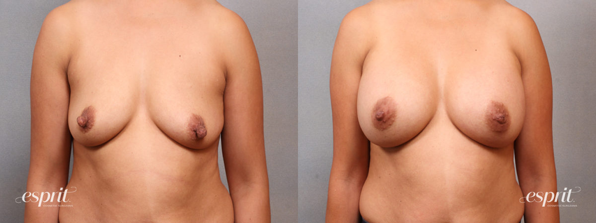 Case 1692 before and after front view esprit® cosmetic surgeons