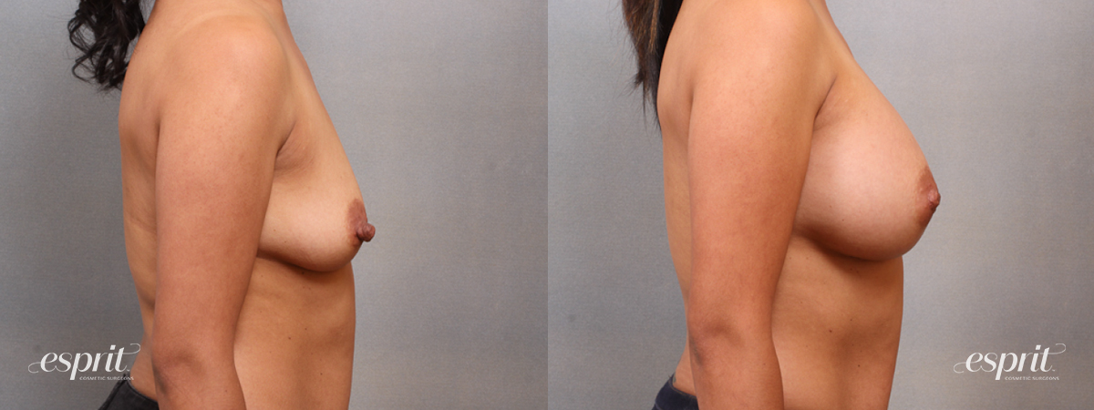 Case 1692 before and after right side view esprit® cosmetic surgeons