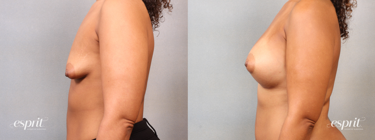 Case 1715 before and after left side view esprit® cosmetic surgeons