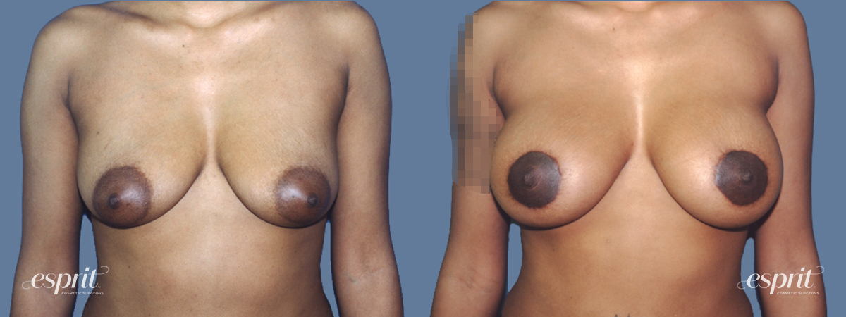 Breast Augmentation 1302, Front