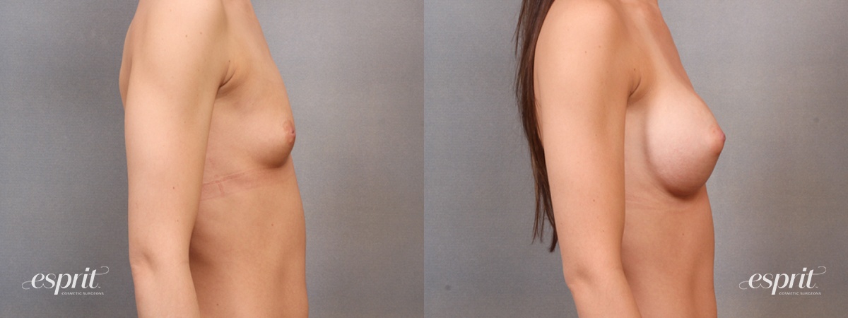 Case 1642 before and after right side view esprit® cosmetic surgeons