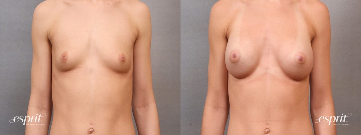 Case 1642 before and after front view esprit® cosmetic surgeons
