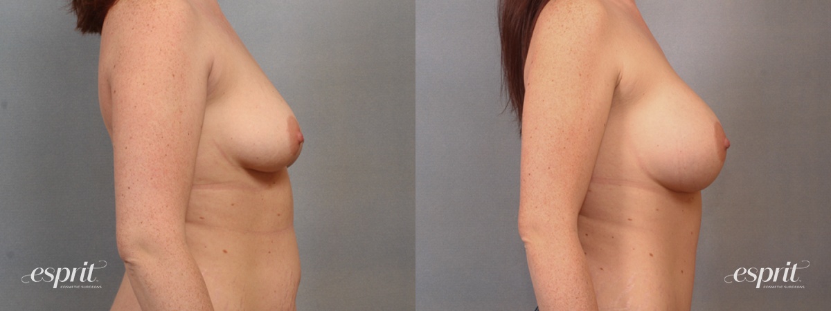 Case 1644 before and after right side view esprit® cosmetic surgeons