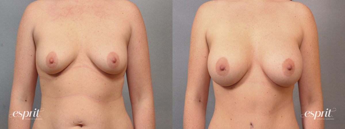 Case 1644 before and after front view esprit® cosmetic surgeons