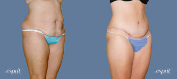 Case 1202 Before and After Right Oblique View