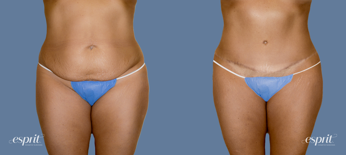 Case 1235 before and after front view esprit® cosmetic surgeons