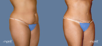 Case 1235 Before and After Right Oblique View