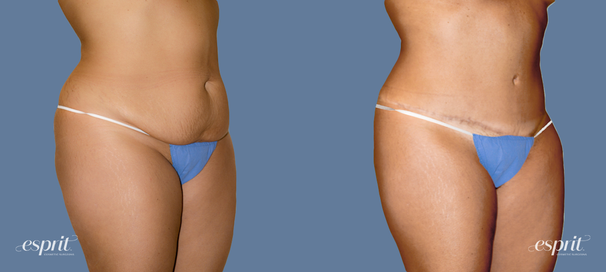 Case 1235 before and after right oblique view esprit® cosmetic surgeons