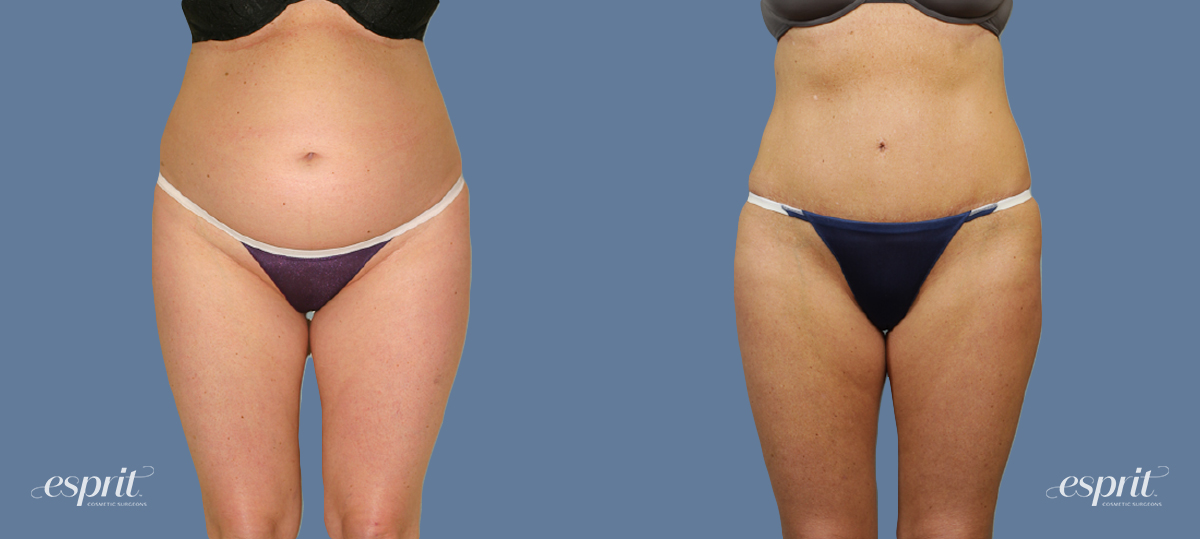 Case 1276 before and after front view esprit® cosmetic surgeons