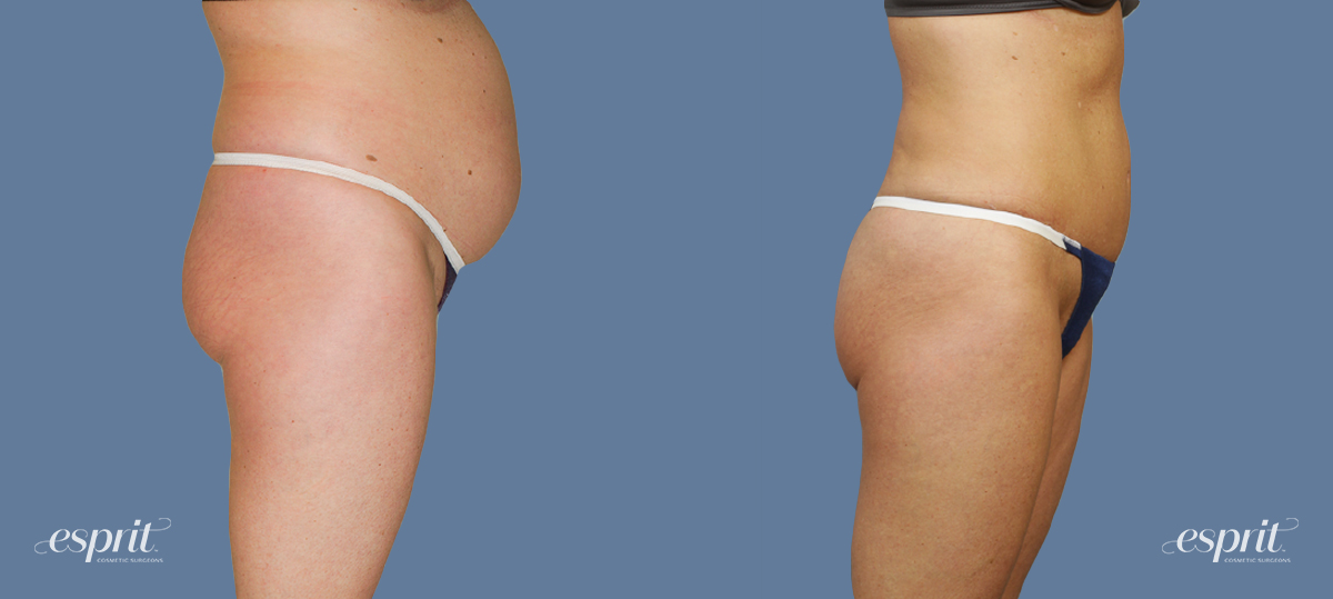 Case 1276 before and after right side view esprit® cosmetic surgeons