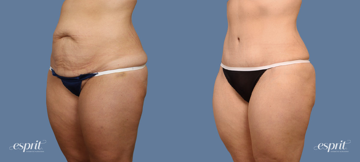 Case 1460 before and after left oblique view esprit® cosmetic surgeons