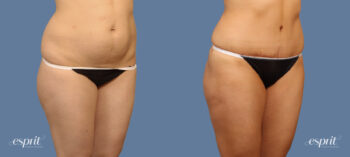 Case 1519 Before and After Right Oblique View