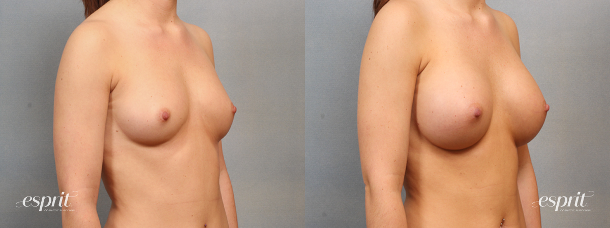 Case 1489 Before and After Right Oblique View