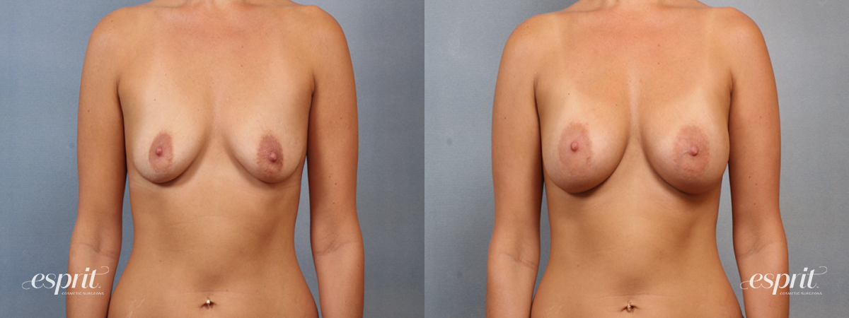 Case 1498 before and after front view esprit® cosmetic surgeons