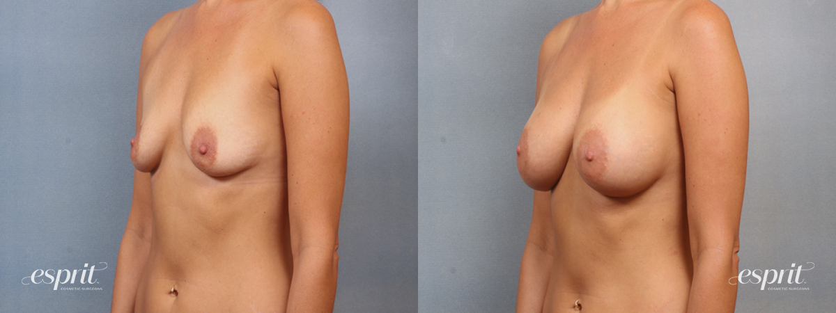 Case 1498 before and after left oblique view esprit® cosmetic surgeons