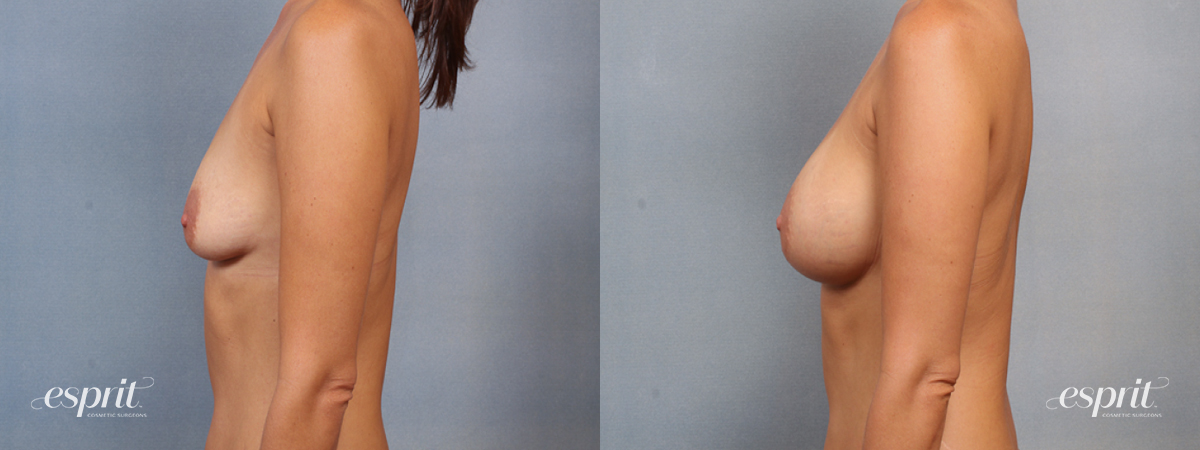 Case 1498 before and after left side view esprit® cosmetic surgeons
