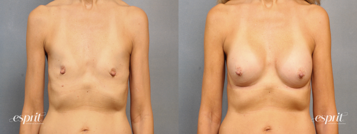 Case 1533 before and after front view esprit® cosmetic surgeons