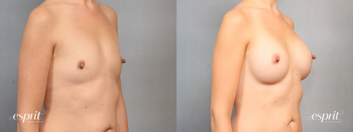 Case 1534 Before and After Right Oblique View