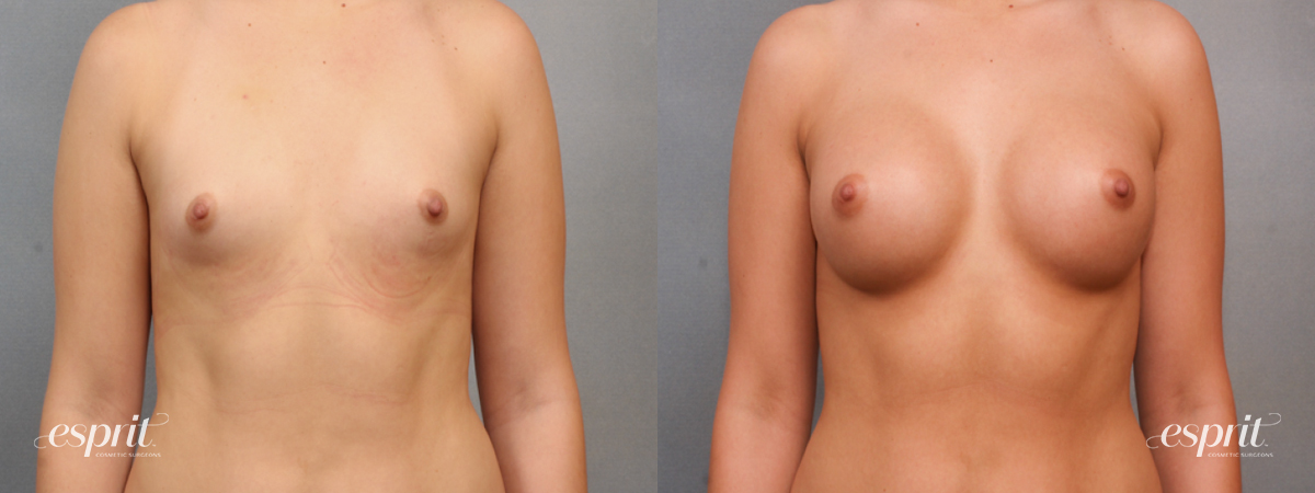 Case 1576 before and after front view esprit® cosmetic surgeons