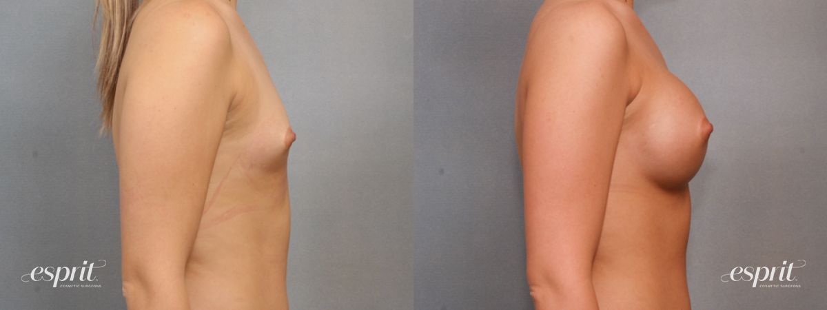 Case 1576 before and after right side view esprit® cosmetic surgeons