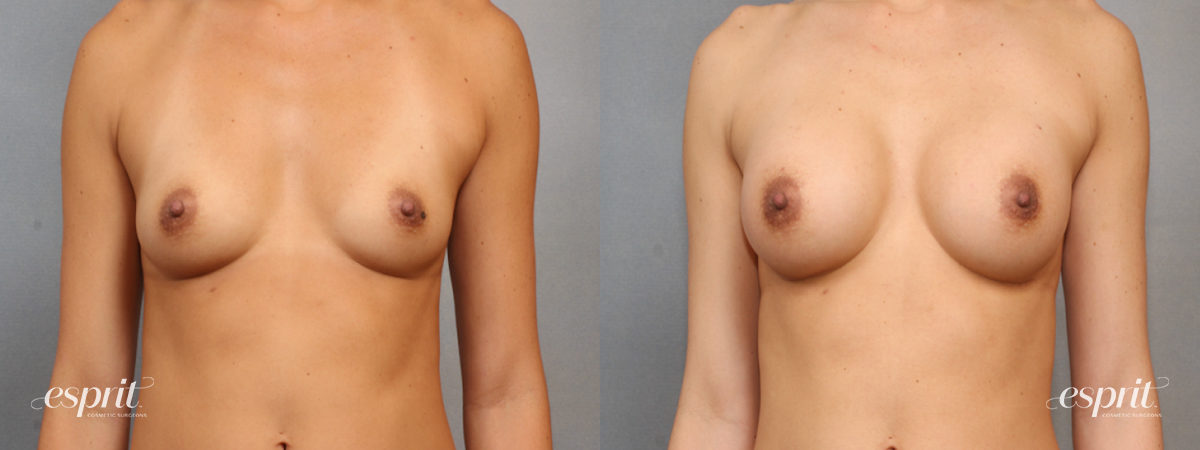 Case 1580 before and after front view esprit® cosmetic surgeons