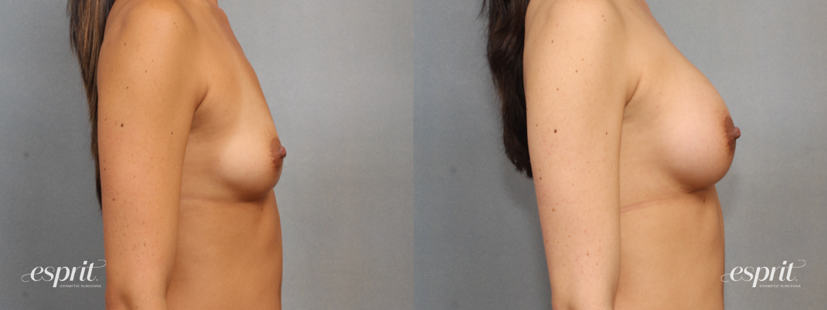 Case 1580 before and after right side view esprit® cosmetic surgeons
