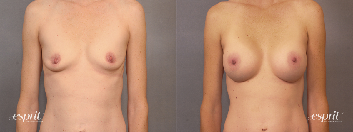 Case 1596 before and after front view esprit® cosmetic surgeons