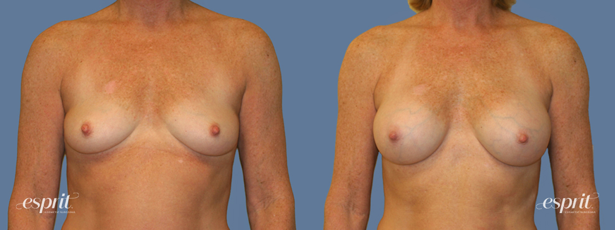 Case 1253 before and after front view esprit® cosmetic surgeons