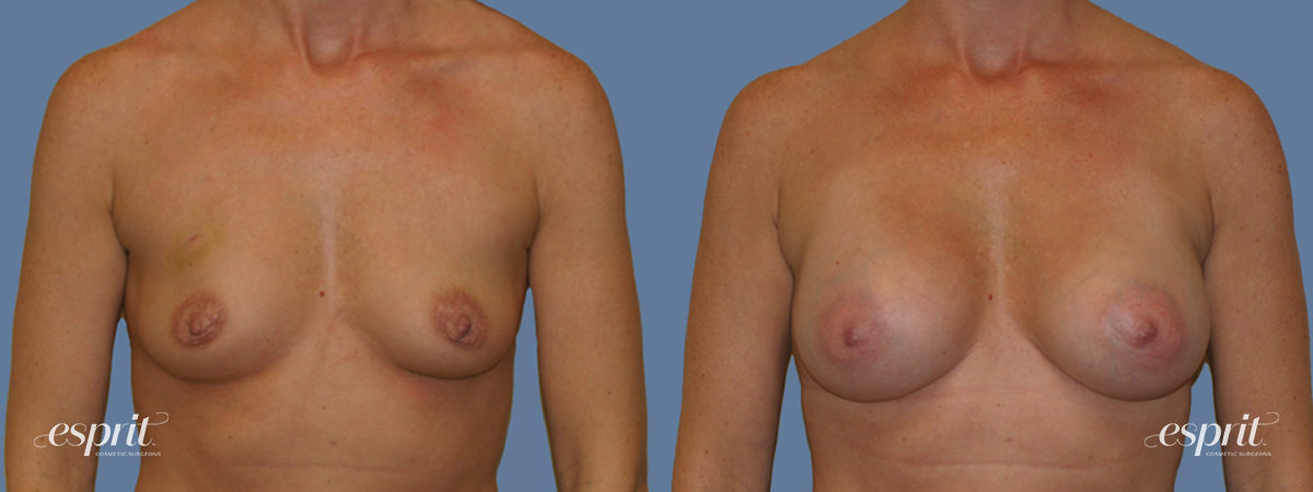Case 1261 before and after front view esprit® cosmetic surgeons