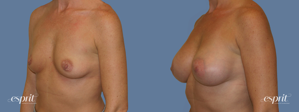 Case 1261 before and after left oblique view esprit® cosmetic surgeons