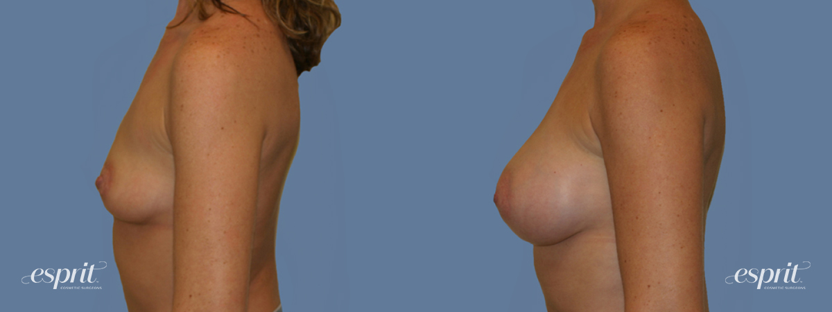 Case 1261 before and after left side view esprit® cosmetic surgeons