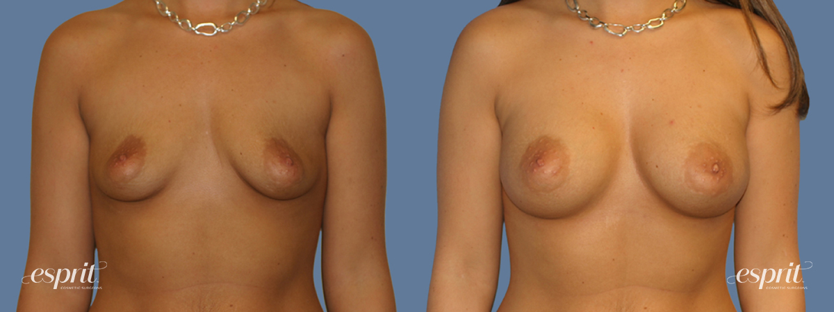 Case 1264 before and after front view esprit® cosmetic surgeons