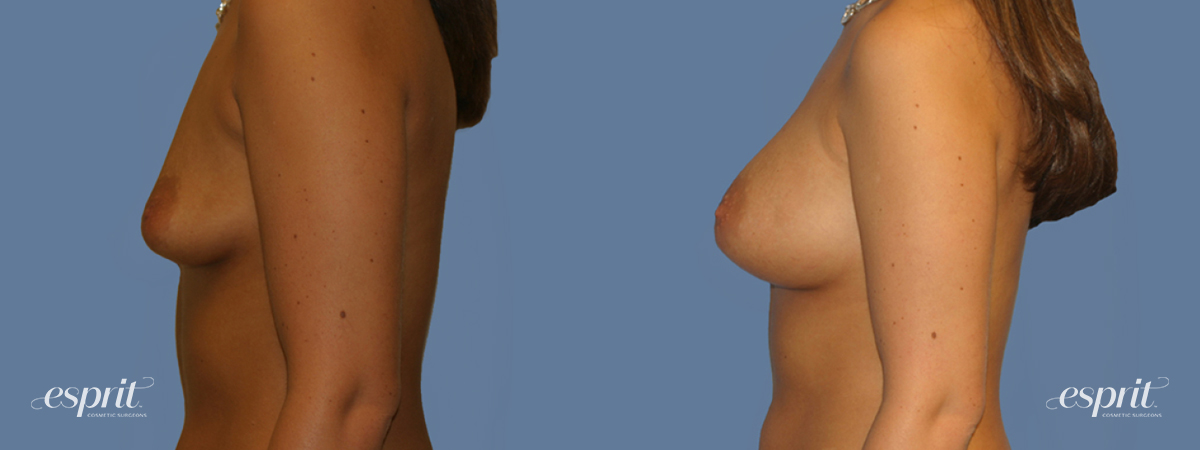 Case 1264 before and after left side view esprit® cosmetic surgeons